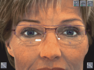 Automatische Pupillenerkennung bei einer Person mit Brille; Pupillenpositionen werden durch Bildverarbeitung präzise markiert.